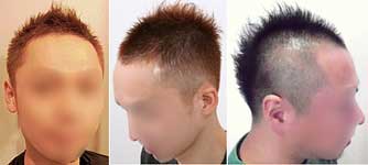 薄毛の種類と特徴 おすすめのヘアスタイル 男の髪型ナビ